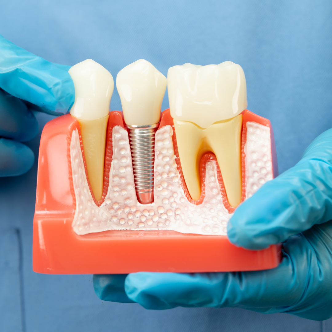 Dental implants in Turkey planned for UK patients using high-quality clinical standards